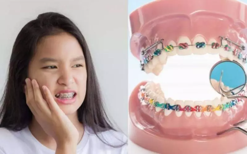 Viêm lợi sau niềng răng là tình trạng khá phổ biến